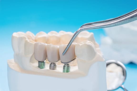 A model of an implant-supported dental bridge