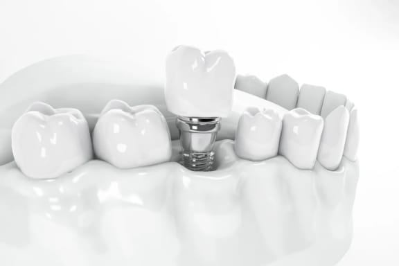 A model showing a dental implant in the jawbone