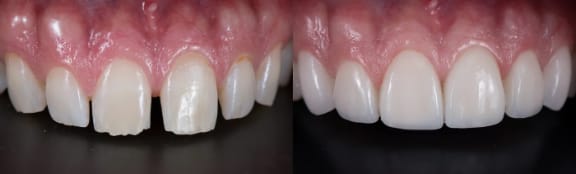 A close-up view of a porcelain veneer
