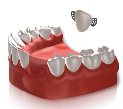 Illustration of a bonded dental bridge